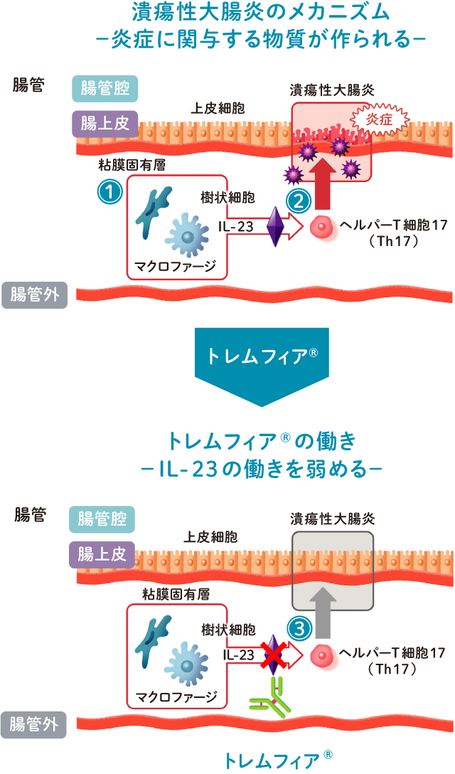 潰瘍性大腸炎患者さんのメカニズム（炎症に関与する物質が作られる）と、トレムフィア®の働き（L-23の働きを弱める）を説明する図